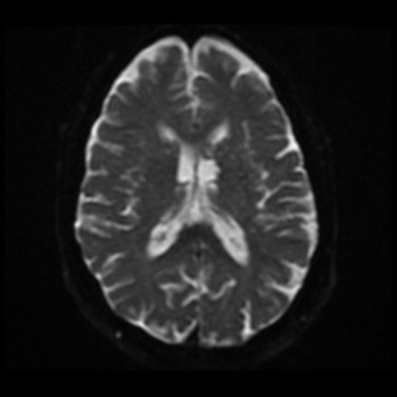 Subependymoma 