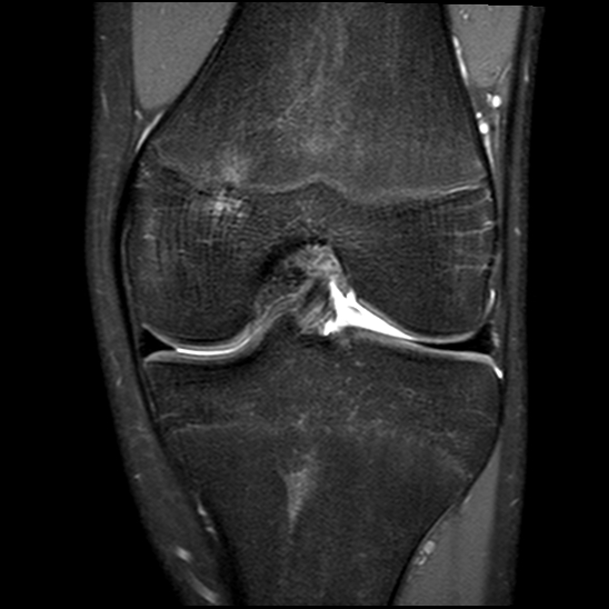 Focal periphyseal edema zone | Image | Radiopaedia.org