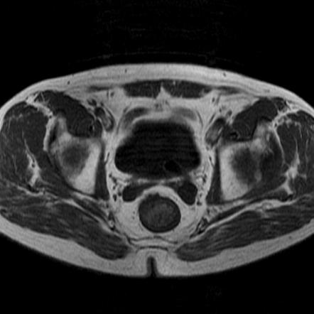 Ureterocoele with non-obstructive calculus | Image | Radiopaedia.org