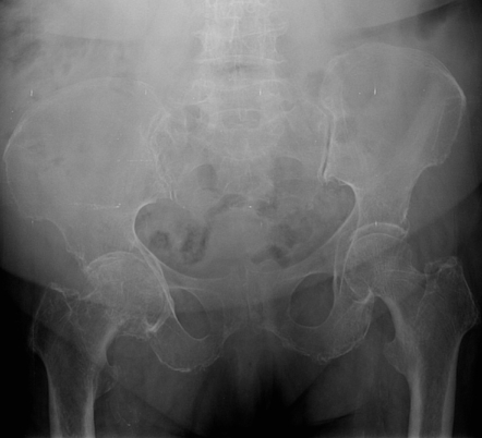 Osteoarthritis of the hip | Radiology Reference Article | Radiopaedia.org