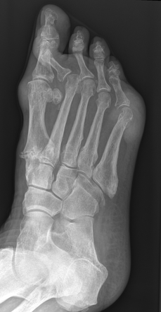 Gout | Image | Radiopaedia.org