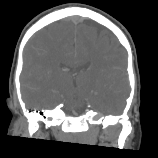 Dural Venous Sinus Thrombosis Image 8515