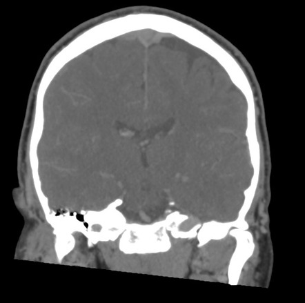 Dural venous sinus thrombosis | Image | Radiopaedia.org