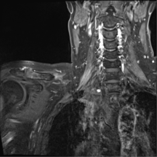 Radiation-induced brachial plexopathy | Image | Radiopaedia.org