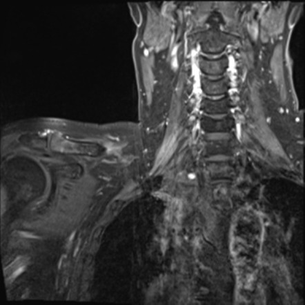 Radiation-induced Brachial Plexopathy 