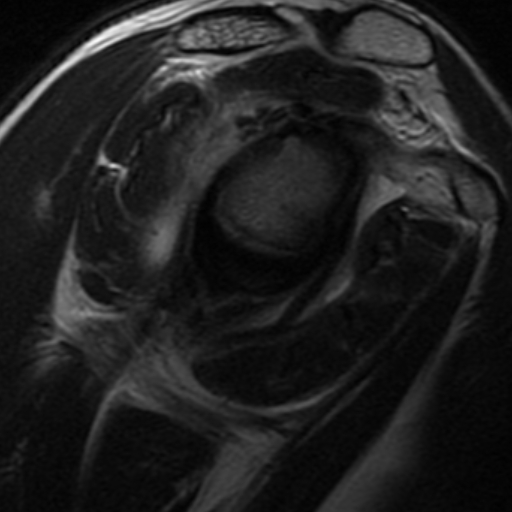 Calcific Periarthritis Of The Shoulder Joint Image