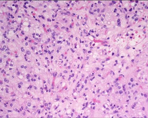 von Hippel Lindau disease - multiple hemangioblastomas | Image ...