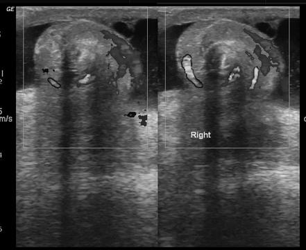 Testicular torsion | Image | Radiopaedia.org