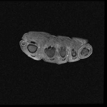 Morton Neuroma | Image | Radiopaedia.org