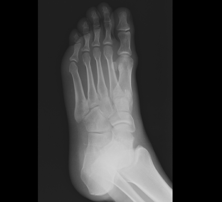 Medial cuneiform fracture | Image | Radiopaedia.org