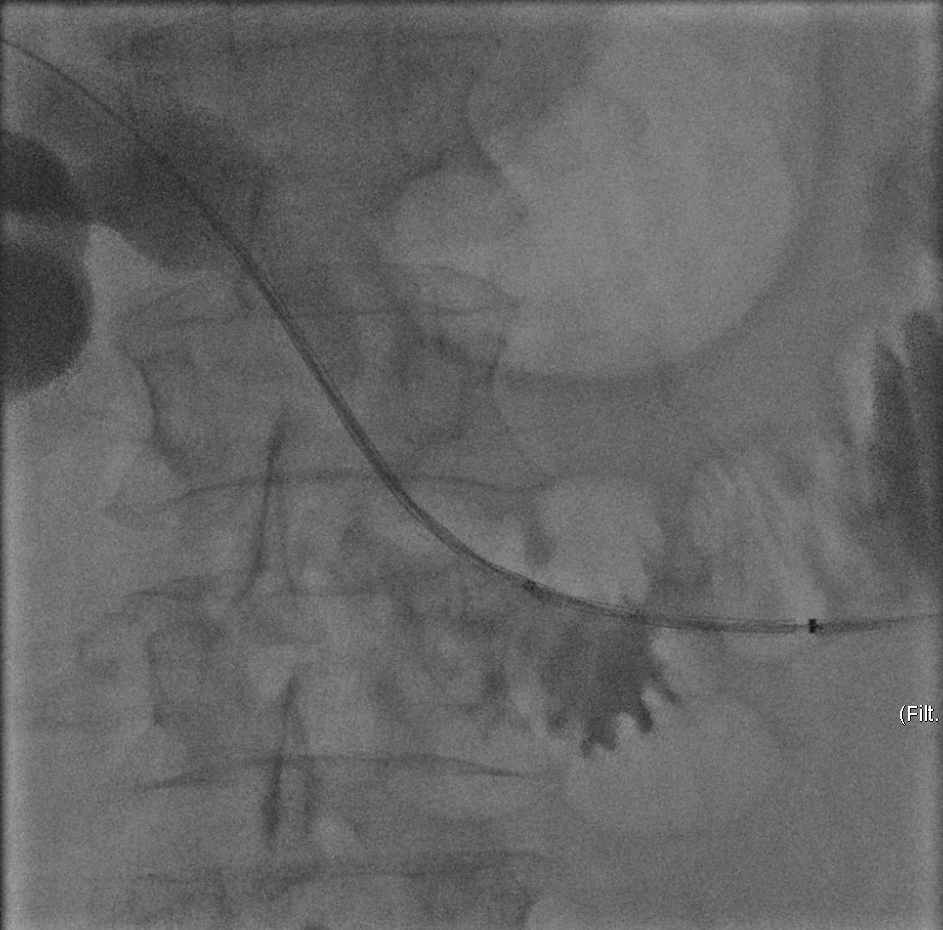 Percutaneous biliary stenting | Image | Radiopaedia.org