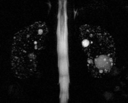 Lithium Induced Renal Disease Radiology Reference Article Radiopaedia Org