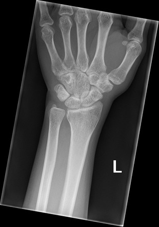 Regional osteopenia | Radiology Case | Radiopaedia.org