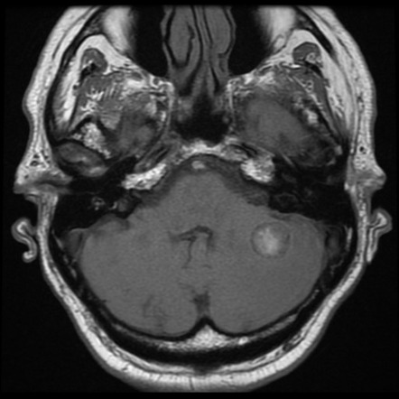 Viewing playlist: 2B - Neuro | Radiopaedia.org