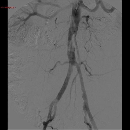 PTA of an aortic in-stent re-stenosis | Radiology Case | Radiopaedia.org