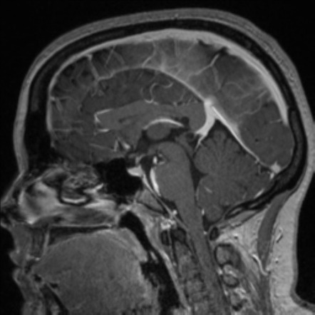 Pineal cyst - small | Image | Radiopaedia.org