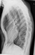 radiografía de pectus excavatum