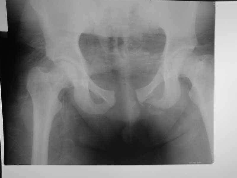 Open Book Pelvic Fracture