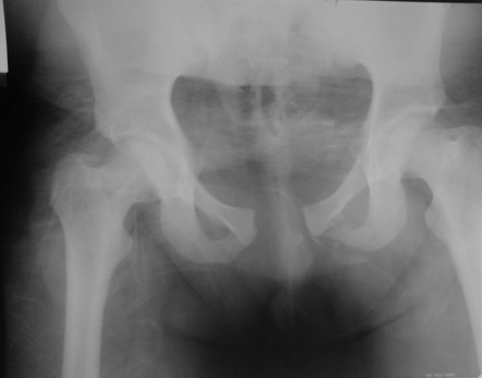 Open book pelvic injury, Radiology Reference Article