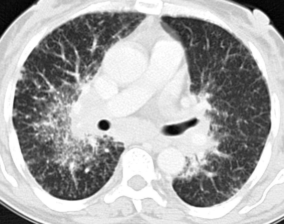 Кт картина саркоидоза легких