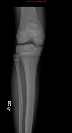 Osteopetrosis | Radiology Case | Radiopaedia.org