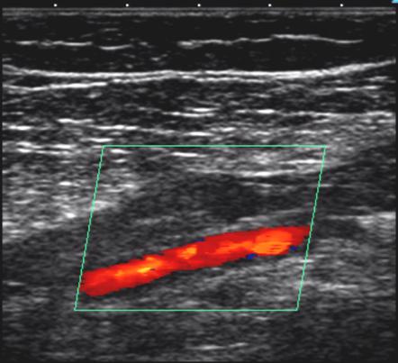 Deep vein thrombosis | Radiology Reference Article | Radiopaedia.org