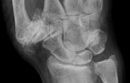 Trapeziometacarpal osteoarthritis | Image | Radiopaedia.org