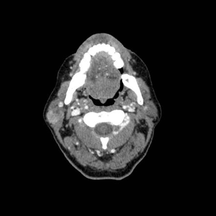 Warthin tumor | Radiology Case | Radiopaedia.org