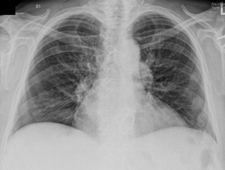 Prosthetic heart valve | Radiology Reference Article | Radiopaedia.org