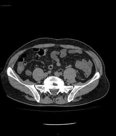 case study 42 acute diverticulitis