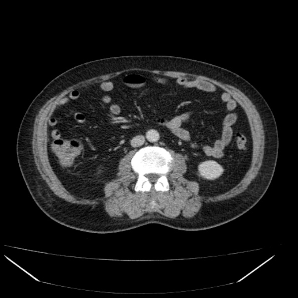 Gangrenous Cholecystitis | Image | Radiopaedia.org