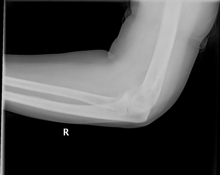 Radial head occult fracture | Image | Radiopaedia.org