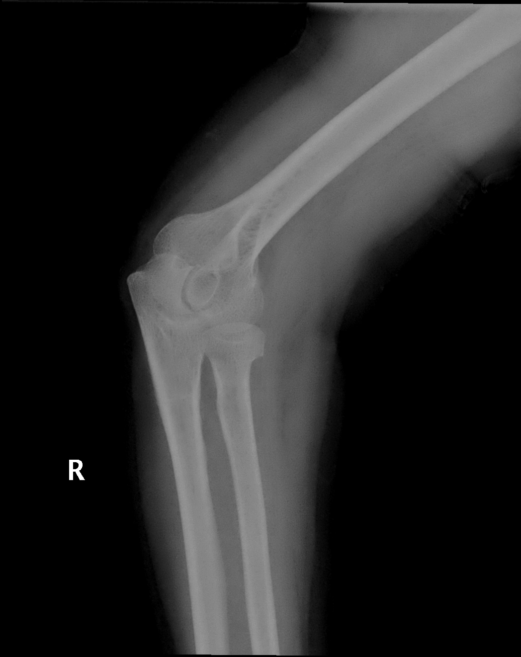 Radial head occult fracture | Image | Radiopaedia.org