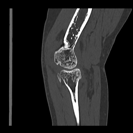 Radial head occult fracture | Image | Radiopaedia.org