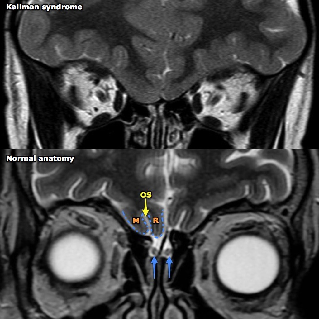 Синдром каллмана фото