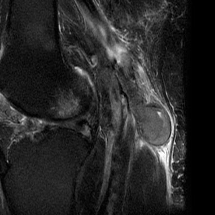 Thrombosed popliteal venous aneurysm | Image | Radiopaedia.org