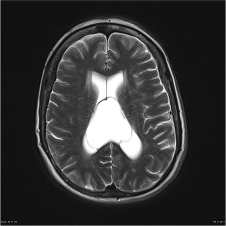 Cavum veli interpositi | Radiology Reference Article | Radiopaedia.org