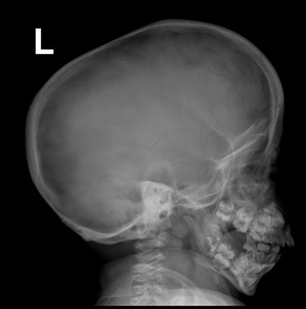 Mucopolysaccharidosis | Image | Radiopaedia.org