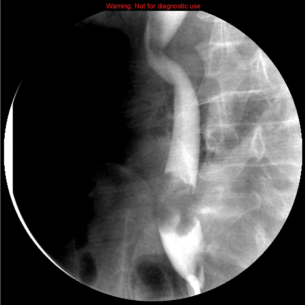 Ureteric transitional cell carcinoma: goblet sign | Image | Radiopaedia.org