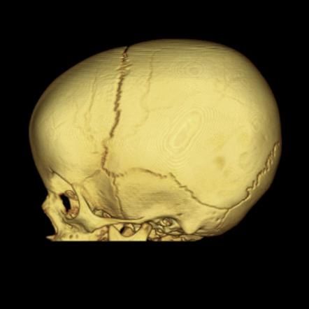 Craniosynostosis | Image | Radiopaedia.org