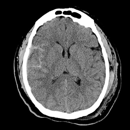 Subarachnoid Hemorrhage Symptoms & Treatment