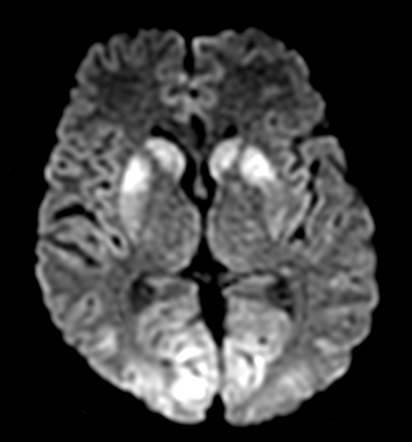 hypoxic injury encephalopathy ischaemic mri ischemic radiopaedia radiology ganglia basal modality