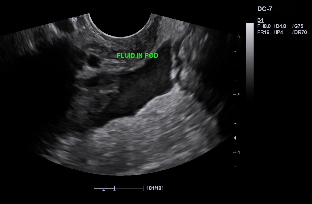 Heterotopic Ectopic Pregnancy Image