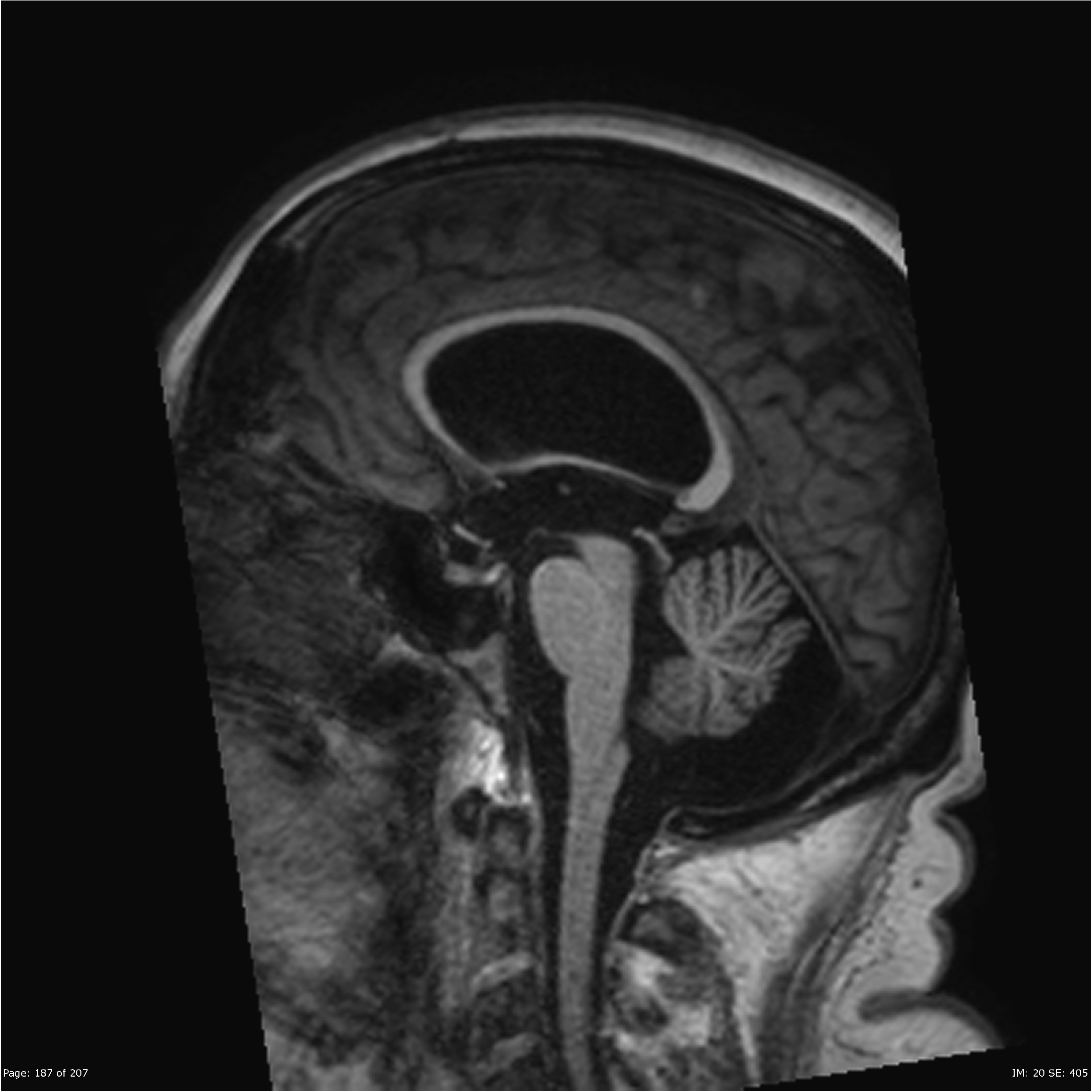 Communicating Hydrocephalus Image