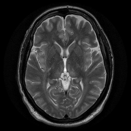 Acute severe hepatic encephalopathy | Image | Radiopaedia.org