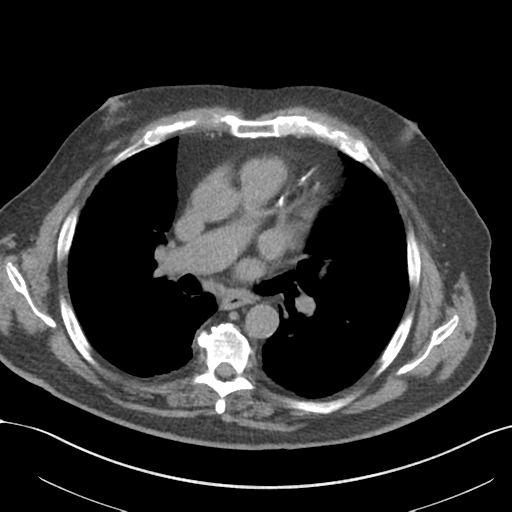 Idiopathic pulmonary fibrosis and lymphocytic interstitial pneumonitis ...