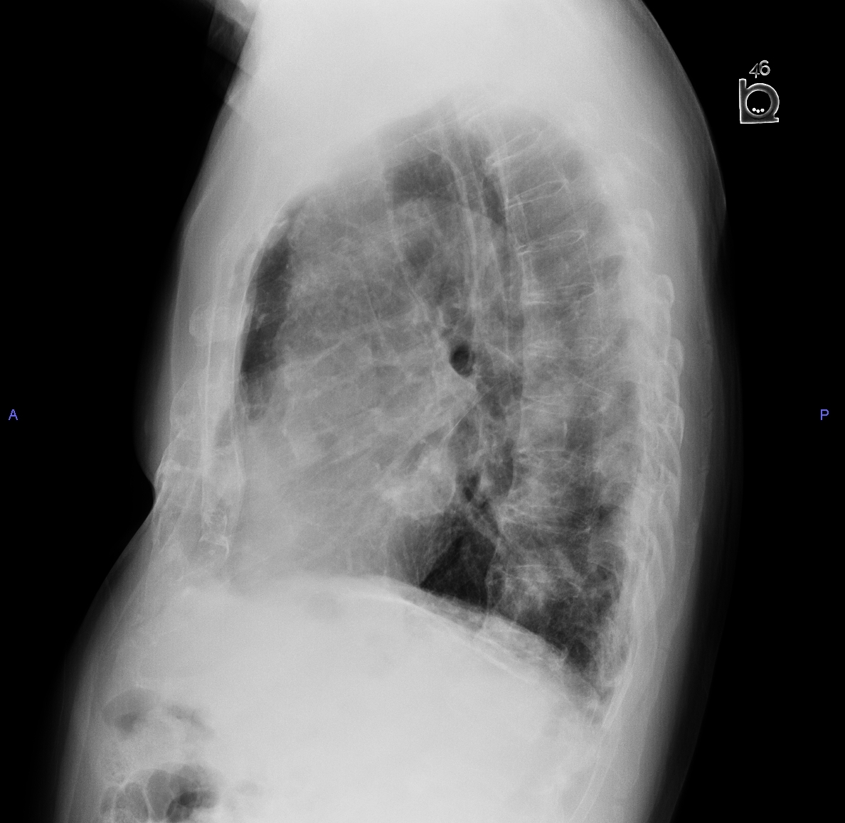 Asbestos-related Pleural Plaques | Image | Radiopaedia.org