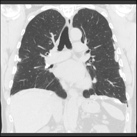 Asbestos-related Pleural Plaques | Image | Radiopaedia.org