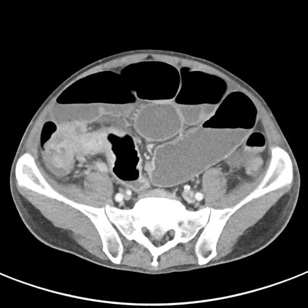 Small bowel obstruction from ileocecal valve adenocarcinoma | Radiology ...