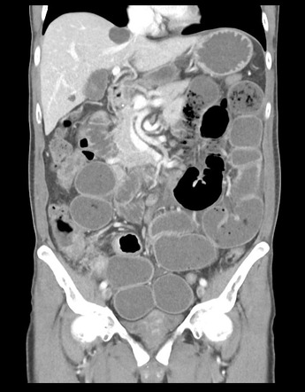 Small bowel obstruction from ileocecal valve adenocarcinoma | Image ...